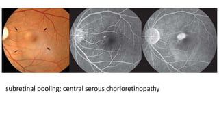 Fundus Fluorescence Angiography | PPTX