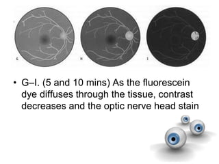 • G–I. (5 and 10 mins) As the fluorescein
dye diffuses through the tissue, contrast
decreases and the optic nerve head stain
 
