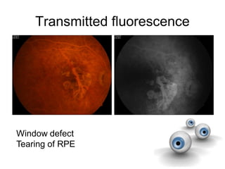 Transmitted fluorescence
Window defect
Tearing of RPE
 