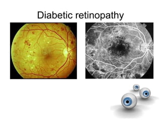 Diabetic retinopathy
 