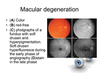 Macular degeneration
• (A) Color
• (B) red-free
• (C) photgraphs of a
fundus with soft
drusen and
hyperpigmentation.
Soft drusen
hyperfluoresce during
the early phase of
angiography (D)stain
in the late phase
 