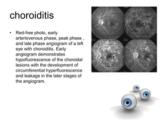 choroiditis
• Red-free photo, early
arteriovenous phase, peak phase ,
and late phase angiogram of a left
eye with choroiditis. Early
angiogram demonstrates
hypofluorescence of the choroidal
lesions with the development of
circumferential hyperfluorescence
and leakage in the later stages of
the angiogram.
 