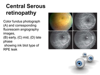 Central Serous
retinopathy
Color fundus photograph
(A) and corresponding
fluorescein angiography
images,
(B) early, (C) mid, (D) late
phase
showing ink blot type of
RPE leak
 