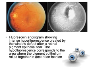 • Fluorescein angiogram showing
intense hyperfluorescence created by
the window defect after a retinal
pigment epithelial tear. The
hypofluorescence corresponds to the
area where the pigment epithelium
rolled together in accordion fashion
 