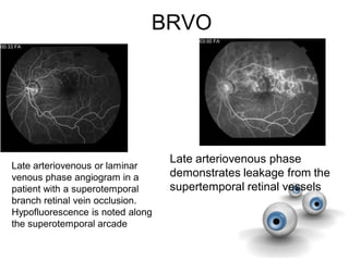 BRVO
Late arteriovenous phase
demonstrates leakage from the
supertemporal retinal vessels
Late arteriovenous or laminar
venous phase angiogram in a
patient with a superotemporal
branch retinal vein occlusion.
Hypofluorescence is noted along
the superotemporal arcade
 