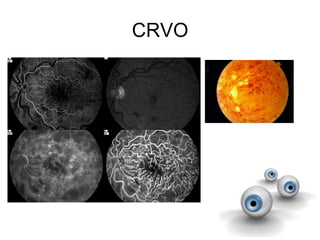 CRVO
 
