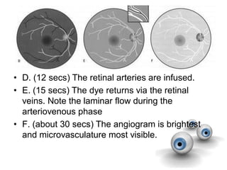 • D. (12 secs) The retinal arteries are infused.
• E. (15 secs) The dye returns via the retinal
veins. Note the laminar flow during the
arteriovenous phase
• F. (about 30 secs) The angiogram is brightest
and microvasculature most visible.
 