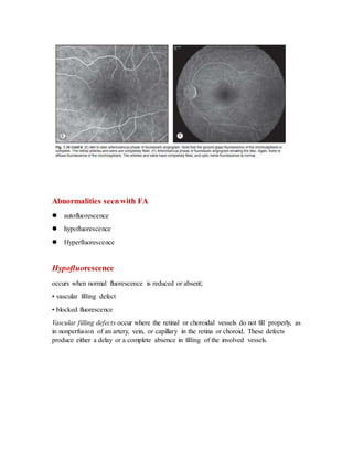 Abnormalities seenwith FA
 autofluorescence
 hypofluorescence
 Hyperfluorescence
Hypofluorescence
occurs when normal fluorescence is reduced or absent;
• vascular filling defect
• blocked fluorescence
Vascular filling defects occur where the retinal or choroidal vessels do not fill properly, as
in nonperfusion of an artery, vein, or capillary in the retina or choroid. These defects
produce either a delay or a complete absence in filling of the involved vessels.
 