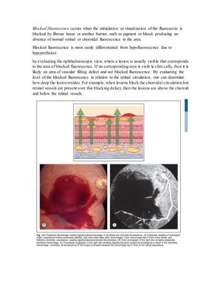 Blocked fluorescence occurs when the stimulation or visualization of the fluorescein is
blocked by fibrous tissue or another barrier, such as pigment or blood, producing an
absence of normal retinal or choroidal fluorescence in the area.
Blocked fluorescence is most easily differentiated from hypofluorescence due to
hypoperfusion
by evaluating the ophthalmoscopic view, where a lesion is usually visible that corresponds
to the area of blocked fluorescence. If no corresponding area is visib le clini cally, then it is
likely an area of vascular filling defect and not blocked fluorescence. By evaluating the
level of the blocked fluorescence in relation to the retinal circulation, one can determine
how deep the lesion resides. For example, when lesions block the choroidal circulation but
retinal vessels are present over this blocking defect, then the lesions are above the choroid
and below the retinal vessels.
 