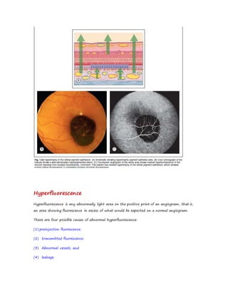 Hyperfluorescence
Hyperfluorescence is any abnormally light area on the positive print of an angiogram, that is,
an area showing fluorescence in excess of what would be expected on a normal angiogram.
There are four possible causes of abnormal hyperfluorescence:
(1) preinjection fluorescence;
(2) transmitted fluorescence;
(3) Abnormal vessels; and
(4) leakage.
 
