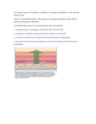 be increased because of the absence of pigment in the pigment epithelium, which normally
forms a visual
barrier to choroidal fluorescence. The major cause of pigment epithelial window defect is
atrophy of the pigment epithelium
Transmitted fluorescence has the following four basic characteristics:
1. It appears early in angiography, coincidental with choroidal filling.
2. It increases in intensity as dye concentration increases in the choroid.
3. It does not increase in size or shape during the later phases of angiography.
4. It tends to fade and sometimes disappear as the choroid empties of dye at the end of
angiography.
 