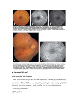 Abnormal Vessels
Abnormal retinal and disc vessels
subtle microvascular changes that cannot be appreciated adequately by ophthalmoscopic
examination will be well defined and easily distinguished by fluorescein angiography. These
changes in the retinal vasculature can be classified into six morphologic categories
(1) tortuosity and dilation
(2) telangiectasis
 