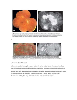 5.
Abnormal choroidal vessels
Abnormal vessels that may be present under the retina and originate from the choroid are
subretinal neovascularization an vessels within a tumor. When subretinal neovascularization is
present, the early angiogram often shows a lacy, irregular, and nodular hyperfluorescence. With
a choroidal tumor, the abnormal hyperfluorescence is a similar, early vascular-type
fluorescence, although it may be coarser, as seen in choroidal hemangioma
 