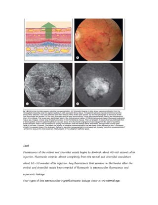 Leak
Fluorescence of the retinal and choroidal vessels begins to diminish about 40–60 seconds after
injection. Fluorescein empties almost completely from the retinal and choroidal vasculature
about 10–15 minutes after injection. Any fluorescence that remains in the fundus after the
retinal and choroidal vessels have emptied of fluorescein is extravascular fluorescence and
represents leakage.
Four types of late extravascular hyperfluorescent leakage occur in the normal eye:
 