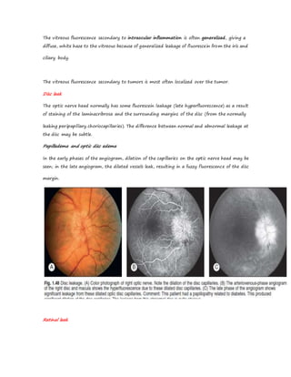 The vitreous fluorescence secondary to intraocular inflammation is often generalized, giving a
diffuse, white haze to the vitreous because of generalized leakage of fluorescein from the iris and
ciliary body.
The vitreous fluorescence secondary to tumors is most often localized over the tumor.
Disc leak
The optic nerve head normally has some fluorescein leakage (late hyperfluorescence) as a result
of staining of the laminacribrosa and the surrounding margins of the disc (from the normally
leaking peripapillary choriocapillaries). The difference between normal and abnormal leakage at
the disc may be subtle.
Papilledema and optic disc edema
In the early phases of the angiogram, dilation of the capillaries on the optic nerve head may be
seen; in the late angiogram, the dilated vessels leak, resulting in a fuzzy fluorescence of the disc
margin.
Retinal leak
 