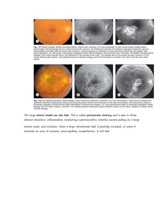 The large retinal vessels can also leak. This is called perivascular staining and is seen in three
distinct situations: inflammation (indicating a perivasculitis), traction (severe pulling on a large
retinal vessel, and occlusion. When a large retinalvessel leak is partially occluded, or when it
traverses an area of occlusion (and capillary nonperfusion), it will leak
 