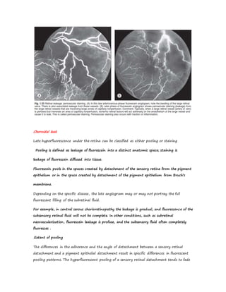 Choroidal leak
Late hyperfluorescence under the retina can be classified as either pooling or staining
Pooling is defined as leakage of fluorescein into a distinct anatomic space; staining is
leakage of fluorescein diffused into tissue.
Fluorescein pools in the spaces created by detachment of the sensory retina from the pigment
epithelium or in the space created by detachment of the pigment epithelium from Bruch’s
membrane.
Depending on the specific disease, the late angiogram may or may not portray the full
fluorescent filling of the subretinal fluid.
For example, in central serous chorioretinopathy the leakage is gradual, and fluorescence of the
subsensory retinal fluid will not be complete. In other conditions, such as subretinal
neovascularization, fluorescein leakage is profuse, and the subsensory fluid often completely
fluoresces .
.Extent of pooling
The differences in the adherence and the angle of detachment between a sensory retinal
detachment and a pigment epithelial detachment result in specific differences in fluorescent
pooling patterns. The hyperfluorescent pooling of a sensory retinal detachment tends to fade
 