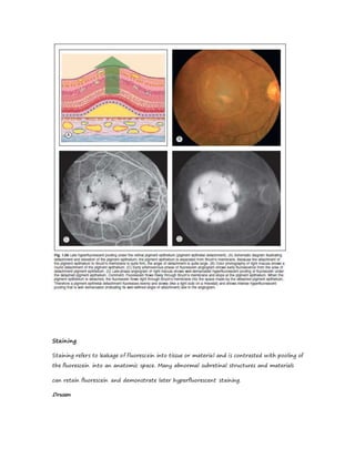 Staining
Staining refers to leakage of fluorescein into tissue or material and is contrasted with pooling of
the fluorescein into an anatomic space. Many abnormal subretinal structures and materials
can retain fluorescein and demonstrate later hyperfluorescent staining.
Drusen
 