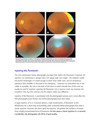 Injecting the fluorescein
The color stereoscopic fundus photographs are taken first, before the fluorescein is injected. For
injection, we recommend a syringe with a 23-gauge scalp-vein needle . The scalpvein needle
has several advantages: it is small enough to enter most visible veins, and an intravenous
opening is then available in the event of an emergency. . Whenever an antecubital vein is not
visible or accessible, the vein in the back of the hand or radial (thumb) side of the wrist can
usually be used for injection. Injecting the fluorescein into a hand or wrist vein increases the
circulation time by a few seconds, but this seldom makes any difference.
Injection of the fluorescein is coordinated with the photographic process and is done after the
first photographs (color fundus and control photographs) have been taken
A rapid injection of 2 or 3 seconds delivers a high concentration of fluorescein to the
bloodstream for a short time and probably yields somewhat better photographs than does a
slower injection. However, the more rapid the injection, the greater the incidence of nausea
from a highly concentrated bolus of fluorescein. For this reason a slower injection (4–6 seconds)
is preferable; the photographs will still be of good quality
 