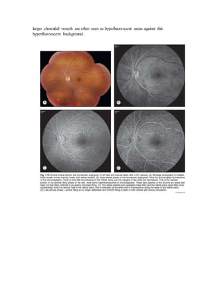 larger choroidal vessels are often seen as hypofluorescent areas against this
hyperfluorescent background.
 