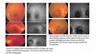 Fundus flurosciein angiograpgy and Autoflurorence SARAVANAN.pptx