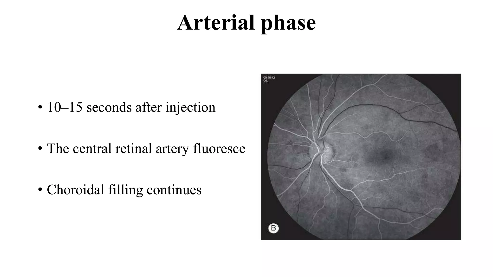 Arterial phase
• 10–15 seconds after injection
• The central retinal artery fluoresce
• Choroidal filling continues
 