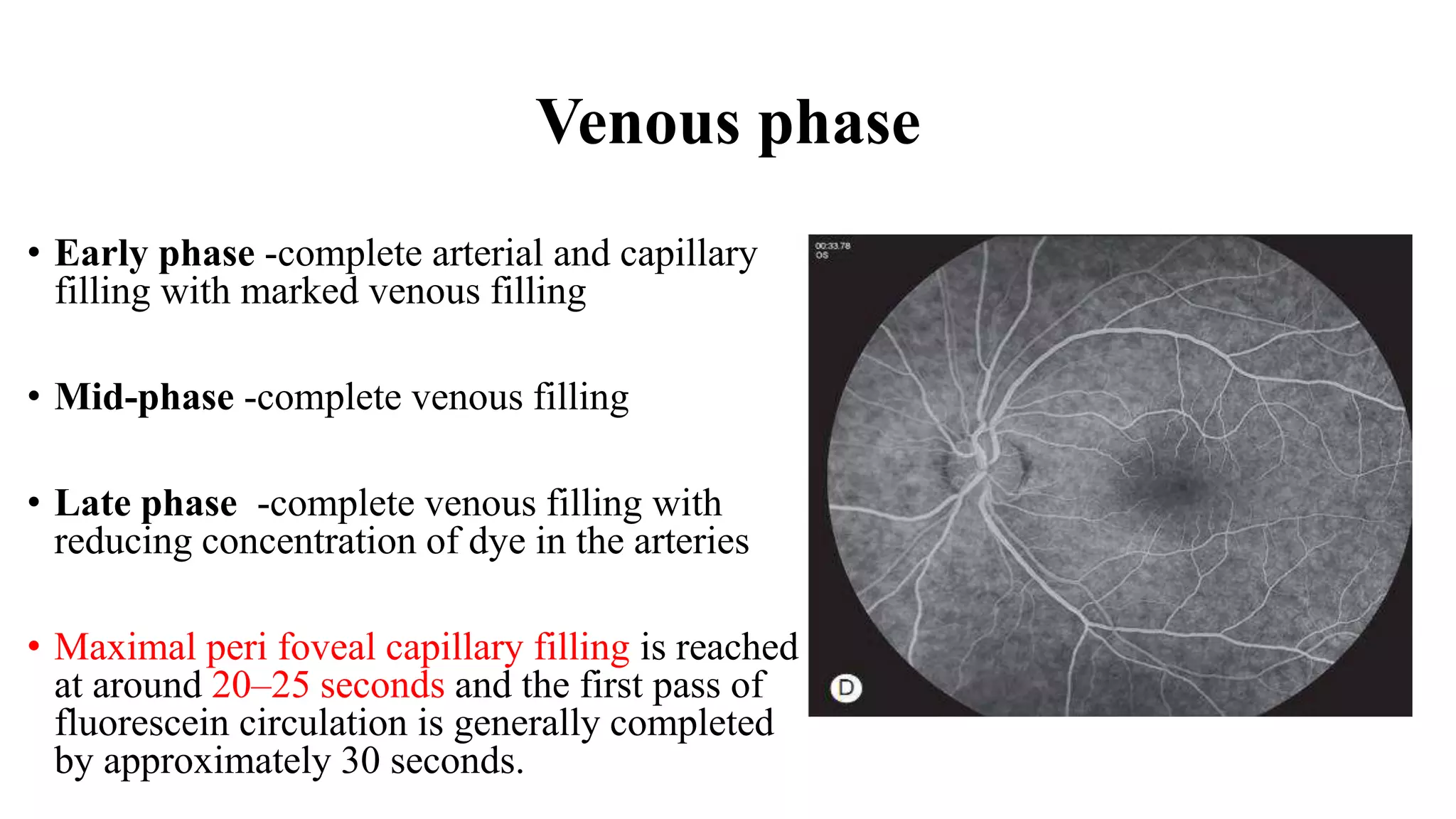 Venous phase
• Early phase -complete arterial and capillary
filling with marked venous filling
• Mid-phase -complete venous filling
• Late phase -complete venous filling with
reducing concentration of dye in the arteries
• Maximal peri foveal capillary filling is reached
at around 20–25 seconds and the first pass of
fluorescein circulation is generally completed
by approximately 30 seconds.
 