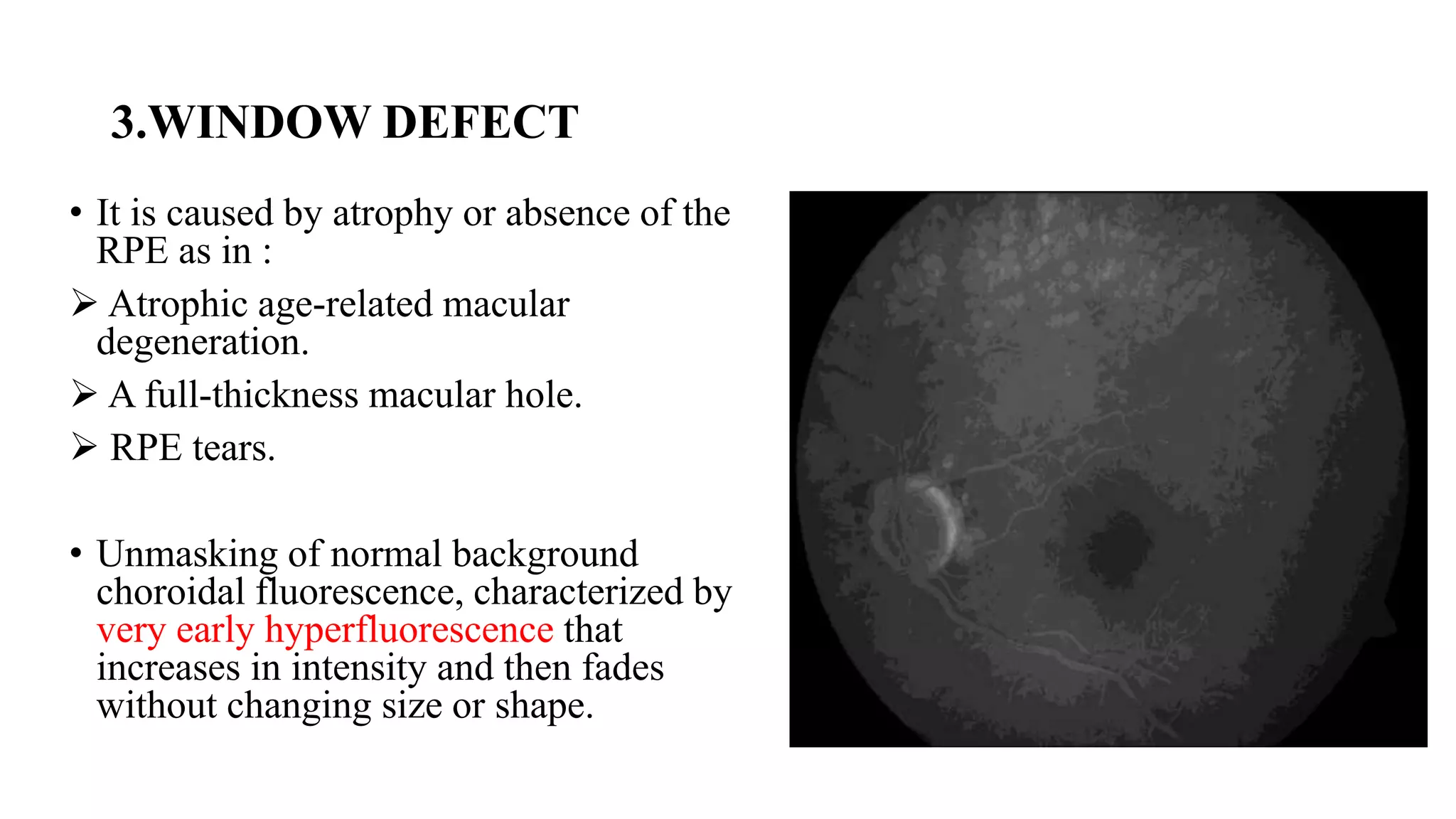 3.WINDOW DEFECT
• It is caused by atrophy or absence of the
RPE as in :
 Atrophic age-related macular
degeneration.
 A full-thickness macular hole.
 RPE tears.
• Unmasking of normal background
choroidal fluorescence, characterized by
very early hyperfluorescence that
increases in intensity and then fades
without changing size or shape.
 