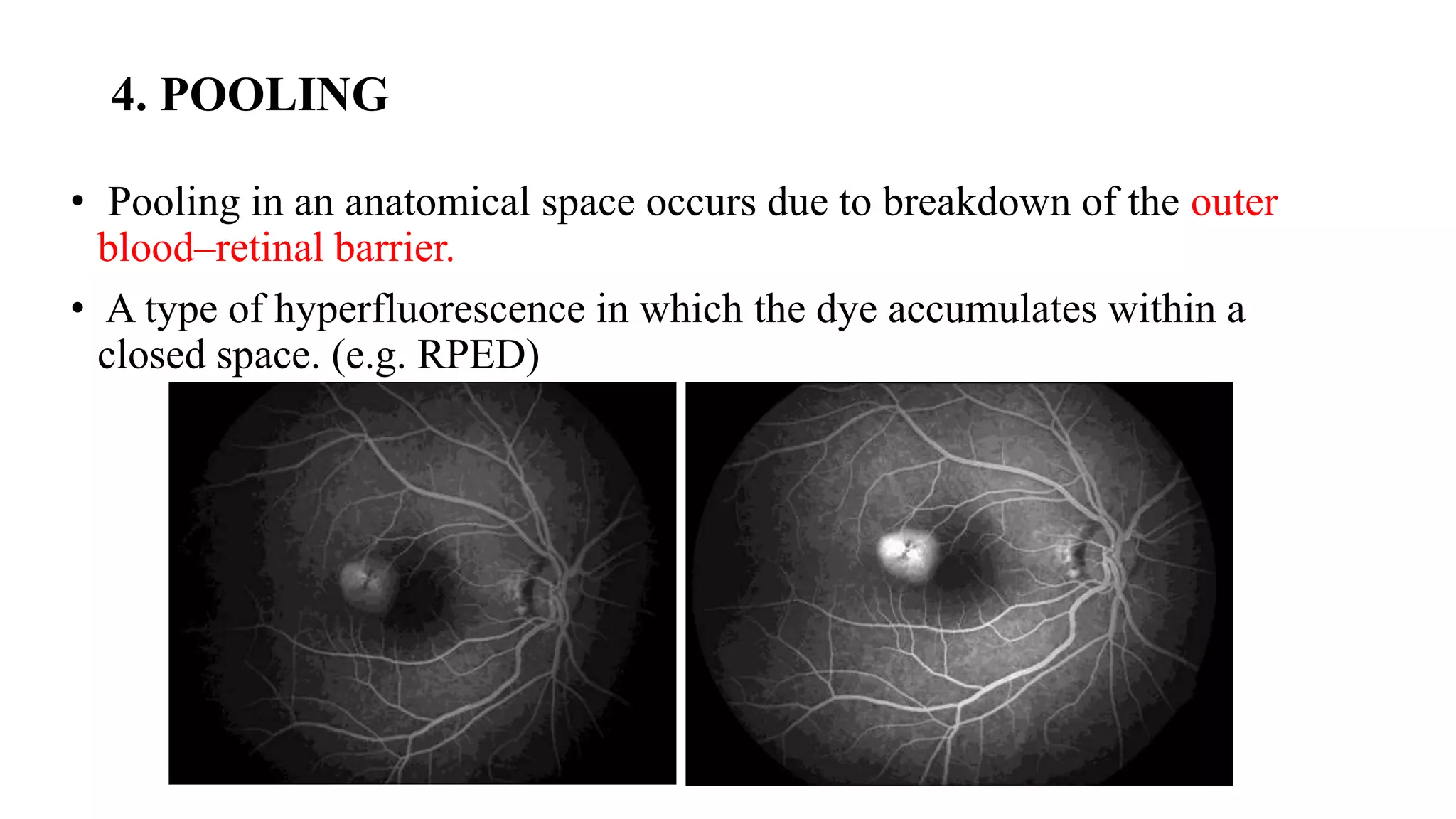 4. POOLING
• Pooling in an anatomical space occurs due to breakdown of the outer
blood–retinal barrier.
• A type of hyperfluorescence in which the dye accumulates within a
closed space. (e.g. RPED)
 