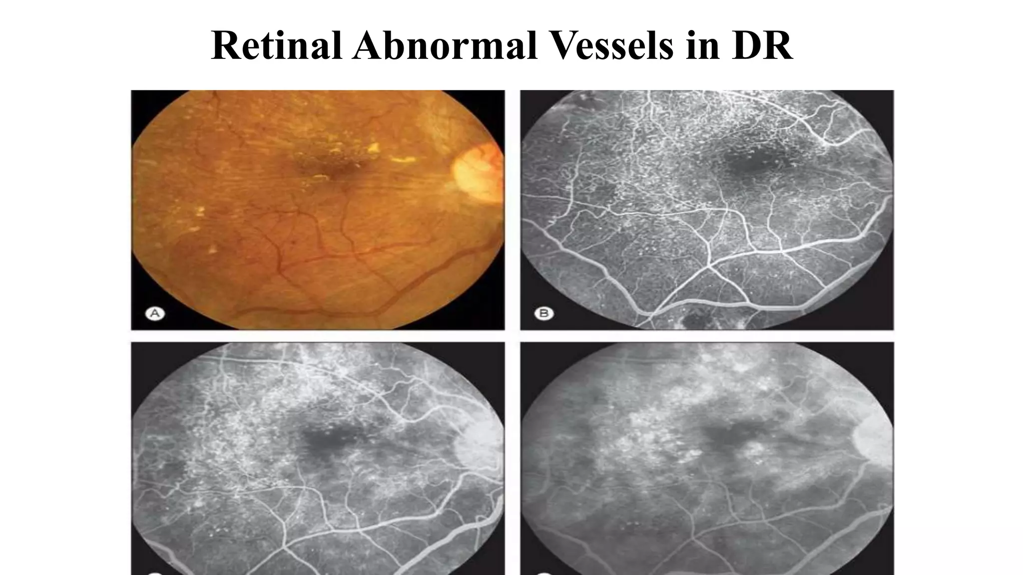 Retinal Abnormal Vessels in DR
 