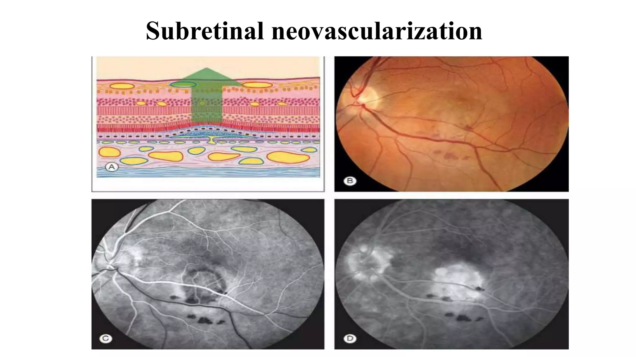 Subretinal neovascularization
 