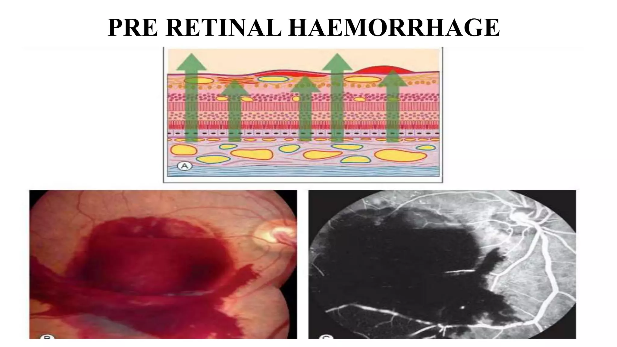 PRE RETINAL HAEMORRHAGE
 