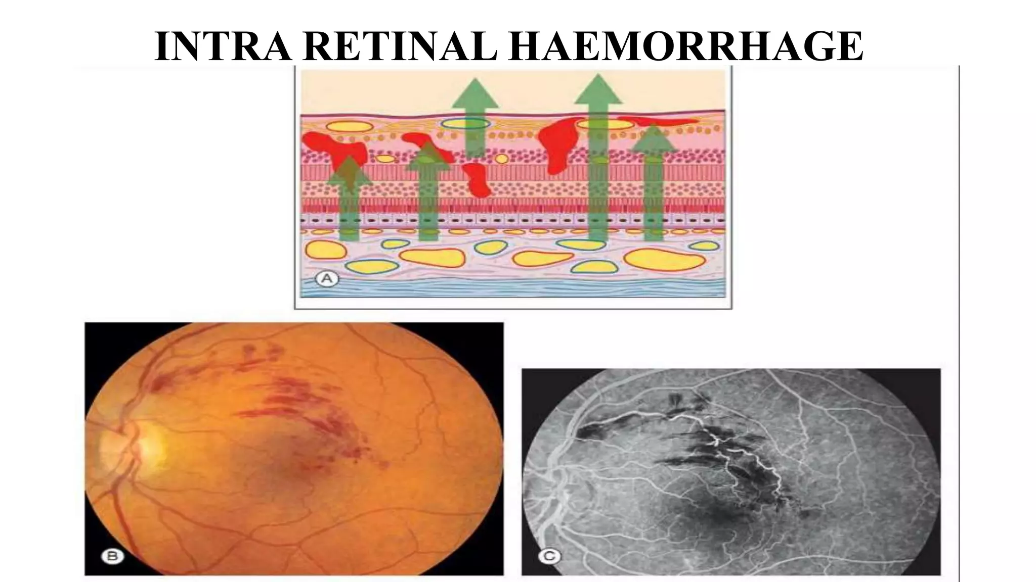 INTRA RETINAL HAEMORRHAGE
 