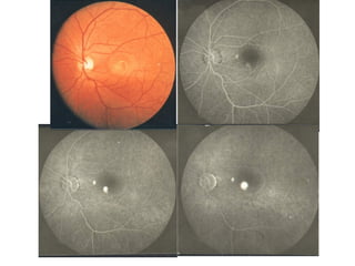 FFA by azmat.PPT best lecture on fundus fluroscien angiography | PPT