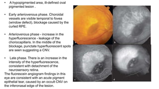 Fundus fluroscein angiography | PPTX