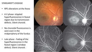 Fundus fluroscein angiography | PPTX
