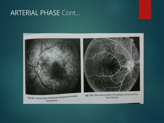 ARTERIAL PHASE Cont…
 