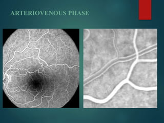 ARTERIOVENOUS PHASE
 