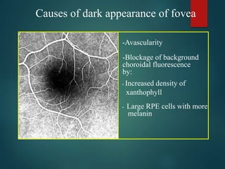 Causes of dark appearance of fovea
-Avascularity
• Increased density of
xanthophyll
• Large RPE cells with more
melanin
-Blockage of background
choroidal fluorescence
by:
 