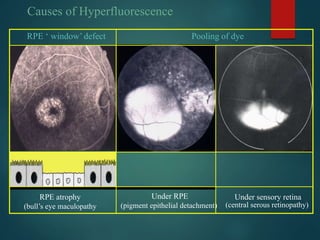 Causes of Hyperfluorescence
RPE ‘ window’ defect
RPE atrophy
(bull’s eye maculopathy
Pooling of dye
Under RPE
(pigment epithelial detachment)
Under sensory retina
(central serous retinopathy)
 
