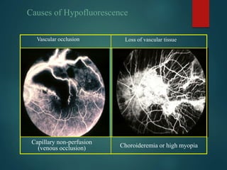 Vascular occlusion
Capillary non-perfusion
(venous occlusion)
Loss of vascular tissue
Choroideremia or high myopia
Causes of Hypofluorescence
 