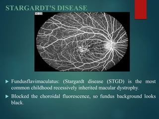 STARGARDT'S DISEASE
 Fundusflavimaculatus: (Stargardt disease (STGD) is the most
common childhood recessively inherited macular dystrophy.
 Blocked the choroidal fluorescence, so fundus background looks
black.
 