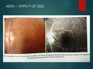 AION – HYPO F OF DISC
 