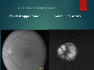 Red-free Fundus photos
Normal appearance Autofluorescence
 