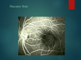 Macular Hole
 
