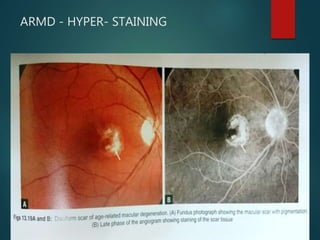 ARMD - HYPER- STAINING
 