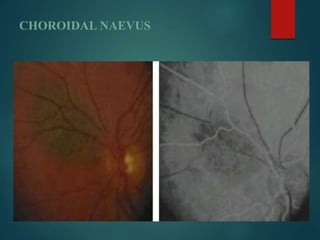 CHOROIDAL NAEVUS
 