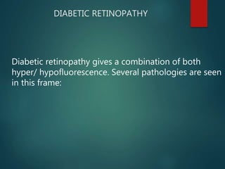 DIABETIC RETINOPATHY
Diabetic retinopathy gives a combination of both
hyper/ hypofluorescence. Several pathologies are seen
in this frame:
 