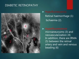 DIABETIC RETINOPATHY
 Hypofluorescence:
Retinal haemorrhage (1)
Ischaemia (2).
 Hyperfluorescence:
microaneurysms (3) and
neovascularization (4)
In addition, there are IRMA
(5) between the retinal
artery and vein and venous
beading (6)
 
