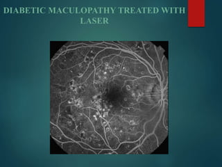 DIABETIC MACULOPATHY TREATED WITH
LASER
 